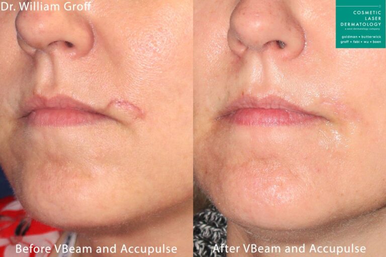 Aculpulse and Vbeam laser used to treat scar above the mouth by Dr. Groff. Treatment leaves scar virtually undetectable.