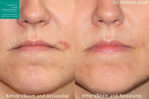 Aculpulse and Vbeam laser used to treat scar above the mouth by Dr. Groff. Treatment leaves scar virtually undetectable.