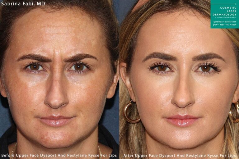 Dysport, Xeomin, and Kysse to treat forehead lines and augment the lips by Dr. Fabi. Treatment erases lines in the upper face and creates fuller lips.
