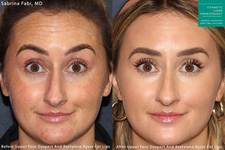 Dysport, Xeomin, and Kysse to treat forehead lines and augment the lips by Dr. Fabi. Treatment erases lines in the upper face and creates fuller lips.