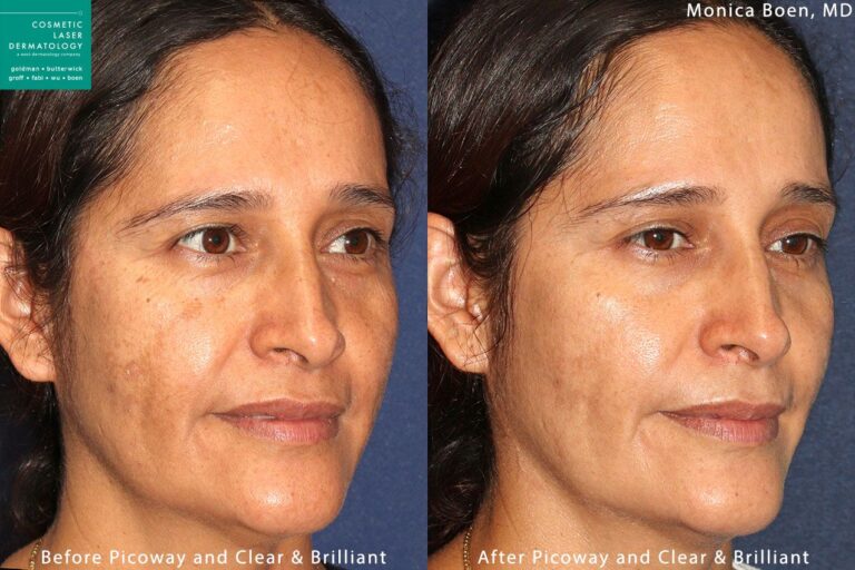 PicoWay and Clear + Brilliant lasers to treat brown spots by Dr. Boen. After treatment, hyperpigmentation is gone and skin is clearer and brighter.