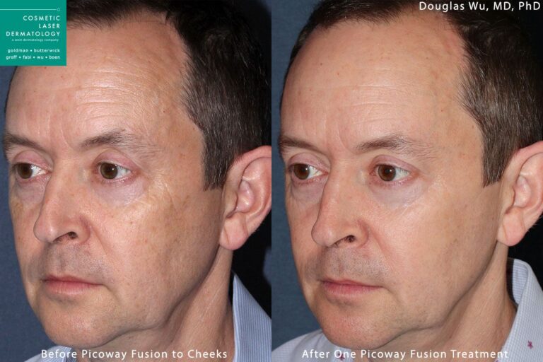 PicoWay laser to remove brown spot by Dr. Wu. Treatment eliminates hyperpigmentation to create clearer, fresher skin.