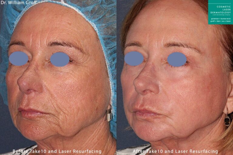 Take 10 treatment with laser resurfacing to rejuvenate the skin by Dr. Groff. Treatment reduces appearance of lines and creates firmer, smoother skin.