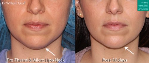 Microlipo and ThermiTight to contour the chin and slim the jawline by Dr. Groff. After treatment, chin is narrower and more defined.