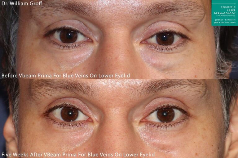 Vbeam Prima to treat reticular veins under the eyes by Dr. Groff. After laser treatments, veins are no longer detectable.