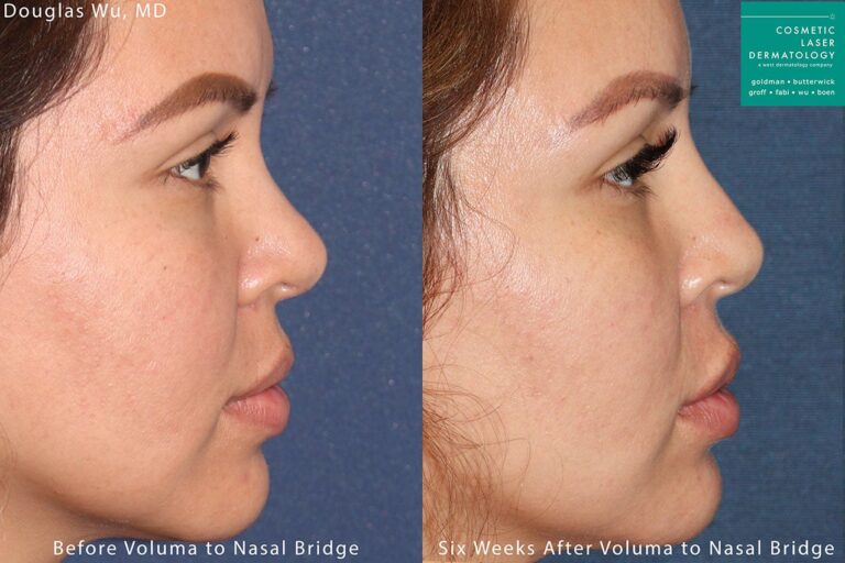 Voluma to enhance nasal bridge by Dr. Wu. After treatment, patient's nasal bridge is improved and profile is enhanced.