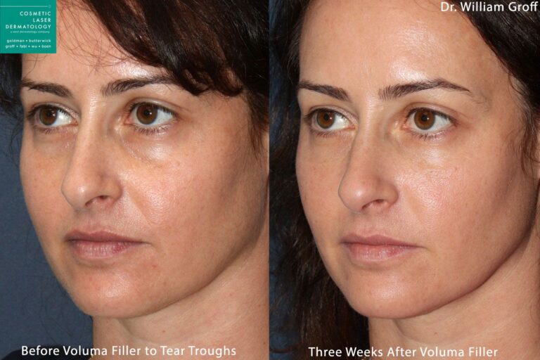 Voluma in tear troughs to rejuvenate eyes by Dr. Groff. After treatment, discoloration and puffiness is reduces and eyes look refreshed.