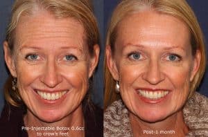 botox wrinkle treatment before and after in san diego, ca