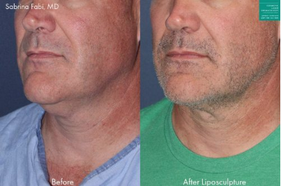 Neck liposuction to remove submental fat from a male patient by Dr. Fabi.