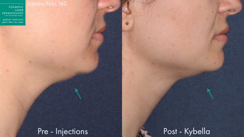 Before and after side image of Kybella treatment on a female's chin performed by Dr. Fabi at our San Diego medical spa