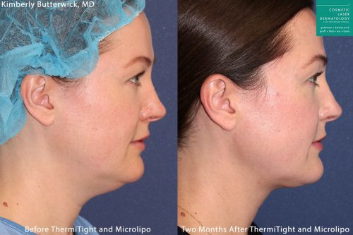 Micro-lipo and ThermiTight for neck and chin contouring by Dr. Butterwick. After procedure, submental is gone and jaw is more defined.