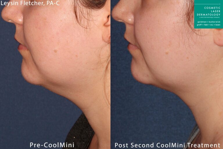 CoolMini to treat submental fat under the chin by Leysin Fletcher, PA-C. After two treatments, submental fat is significantly reduced and chin is more defined.