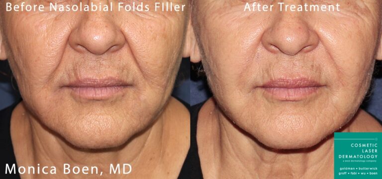 Dermal filler to treat nasolabial folds by Dr. Boen. After injections, creases are visibly reduced and the lower face looks more youthful.