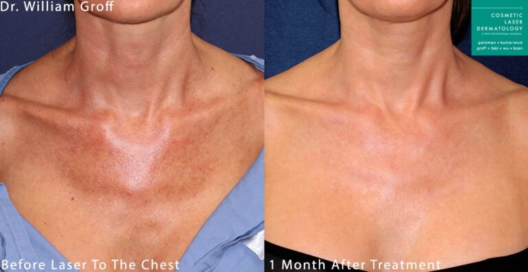 Laser treatment to remove sun damage from chest by Dr. Groff. After treatment, brown spots are gone and skin is smoother and clearer.