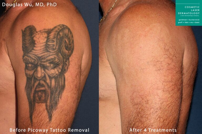PicoWay laser used to remove a tattoo on the upper arm by Dr. Wu. After a series of treatments, ink is nearly completely eliminated.