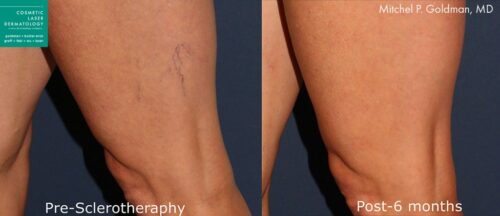 What To Expect From Sclerotherapy in San Diego, CA