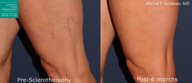 Eliminate Leg Veins and Walk With Confidence - Cosmetic Laser