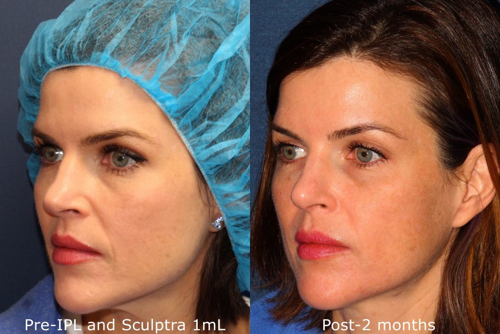 Before and after oblique image of Sculptra treatment on a female's nasolabial folds performed by Dr. Fabi at our San Diego medi spa