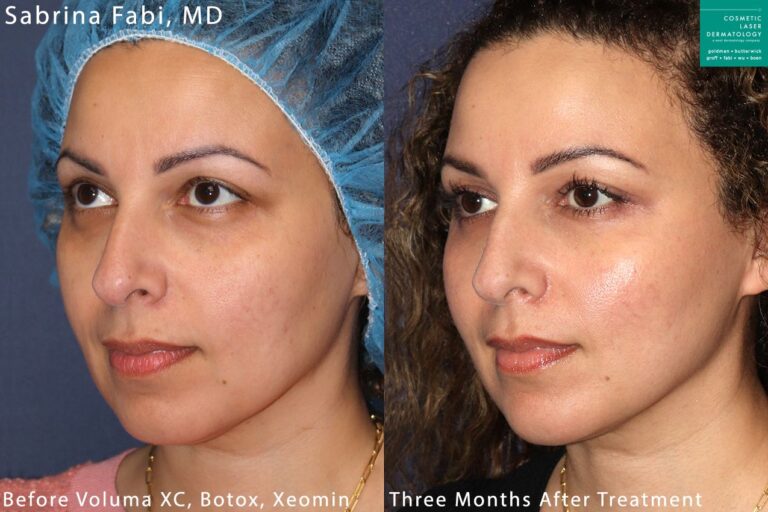 Botox and Voluma for facial rejuvenation by Dr. Fabi. After treatment, facial contour is enhanced and more youthful