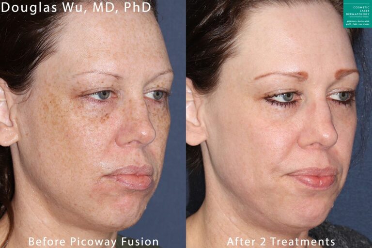 PicoWay Fusion laser used to treat brown spots on face by Dr. Wu. After two treatment sessions, brown spots are nearly gone.