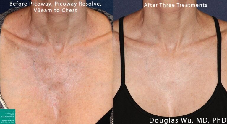 PicoWay, Resolve, and Vbeam lasers used to treat sun damage on chest by Dr. Wu. After treatment, sun damage is gone and chest is clearer.