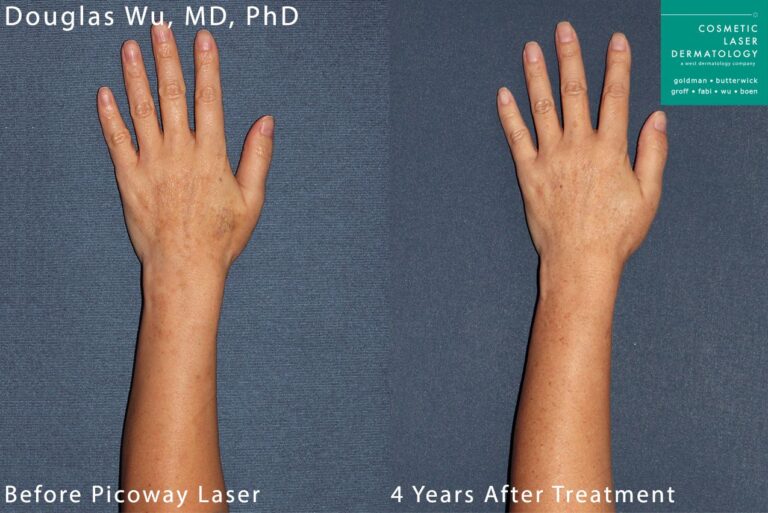 PicoWay laser to remove brown spots on the hands and arms by Dr. Wu. Treatment eliminates hyperpigmentation to create clearer, fresher skin.