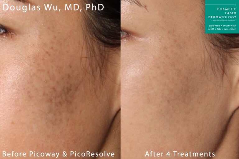 PicoWay laser to treat cheek discoloration by Dr. Wu. After treatment discoloration is significantly reduce and skin is visibly clearer.