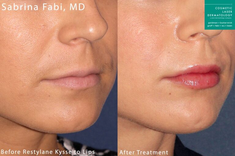 Restylane Kysse used for lip plumping by Dr. Fabi. After treatment, lips are fuller and more shapely.