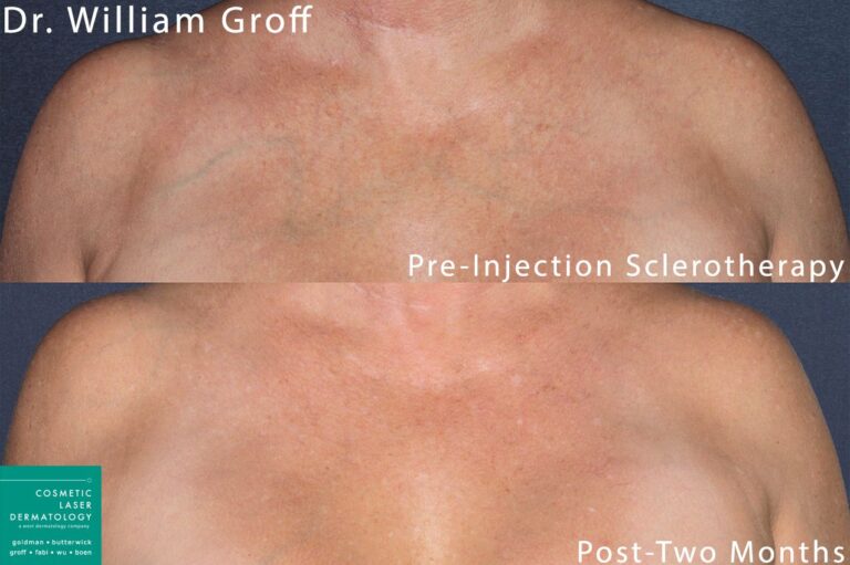 Sclerotherapy to treat visible veins on the chest by Dr. Groff. After treatment, veins are no longer detectable.