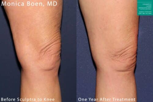 Sculptra used to treat knee wrinkles. After treatment, knee has more volume and fewer lines and wrinkles.