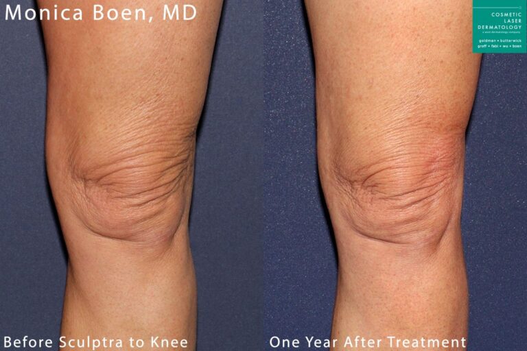 Sculptra used to treat knee wrinkles. After treatment, knee has more volume and fewer lines and wrinkles.