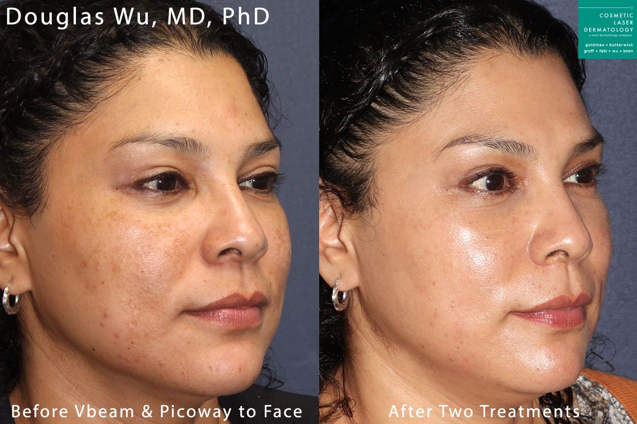 Vbeam and PicoWay lasers used to treat brown spots by Dr. Wu. After two treatments, patient's skin is visibly clearer.