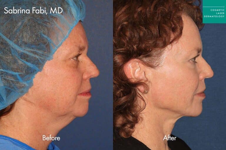 Thermisculpt before and after photos of a female patient at CLDerm