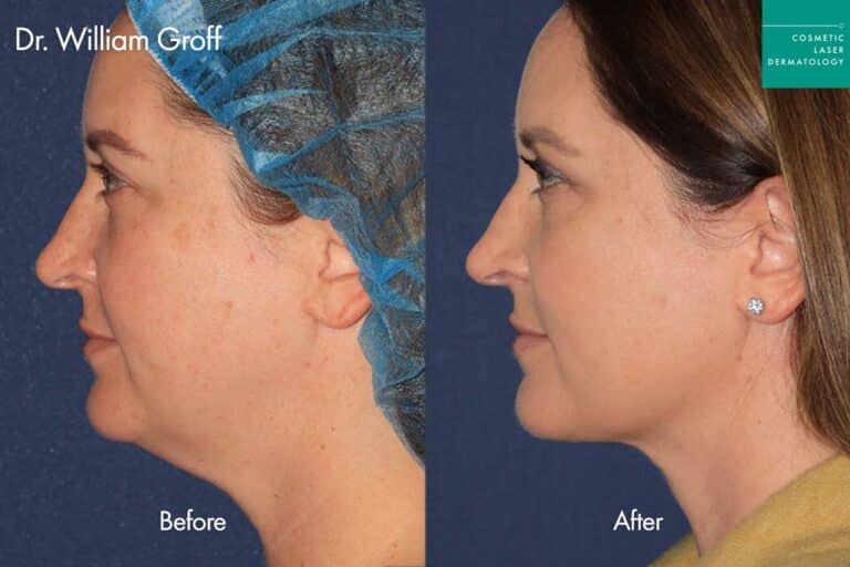Thermisculpt before and after photos of a female patient at CLDerm