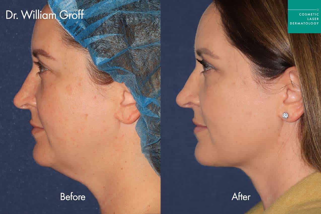 Thermisculpt before and after photos of a female patient at CLDerm