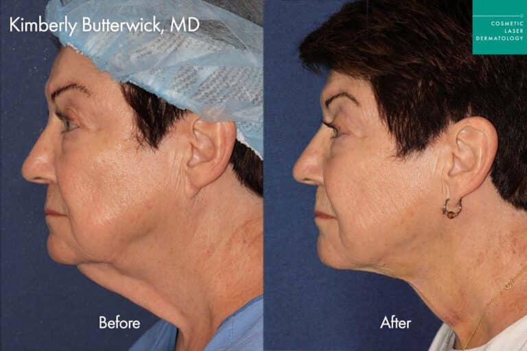 Thermisculpt before and after photos of a female patient at CLDerm
