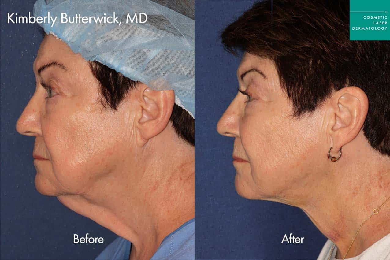 Thermisculpt before and after photos of a female patient at CLDerm