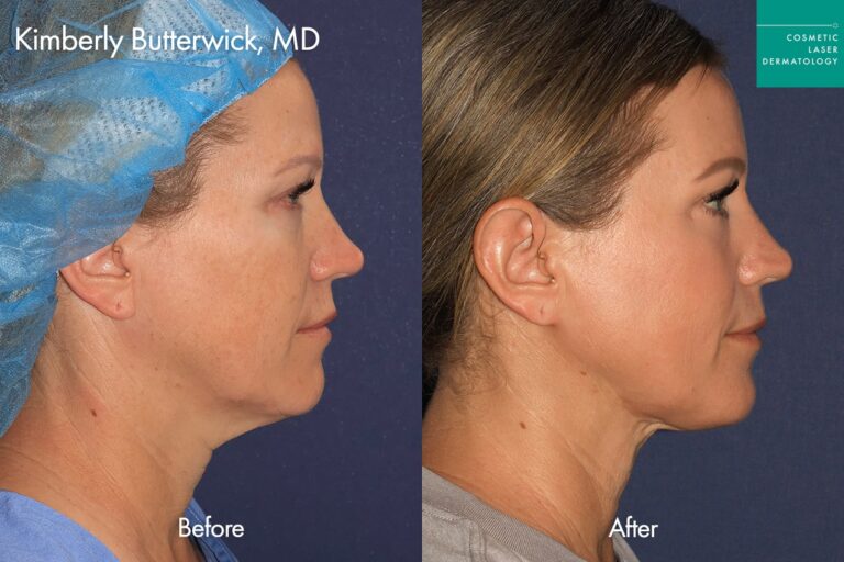 Thermisculpt before and after photos of a female patient at CLDerm