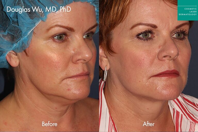 Thermisculpt before and after photos of a female patient at CLDerm