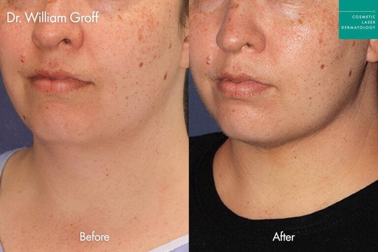 Thermisculpt before and after photos of a female patient at CLDerm