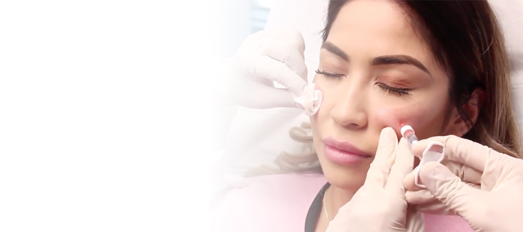 Bellafill Dermal Filler Medical Spa San Diego CA CLDerm