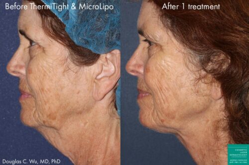 ThermiSculpt skin tightening treatment results in San Diego, CA