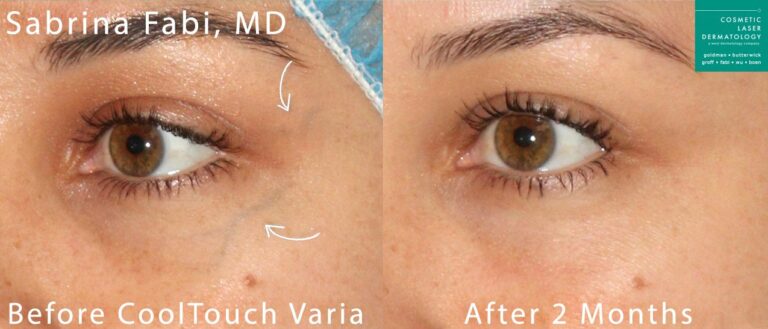 CoolTouch Varia to remove veins from around the eyes by Dr. Fabi. After treatment, visible vein is gone.
