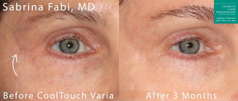 CoolTouch Varia to remove veins from around the eyes by Dr. Fabi. After treatment, visible vein is gone.
