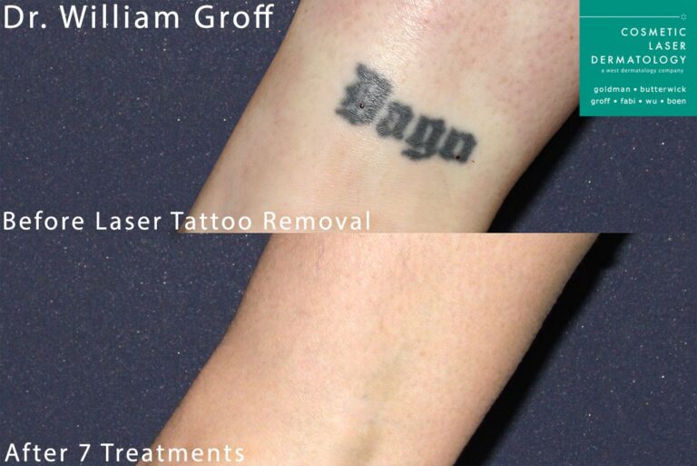 Laser treatment to remove tattoo by Dr. Groff. After 7 sessions, tattoo is gone.