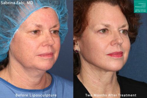 Liposculpture to remove submental fat and sculpt the chin by Dr. Fabi. After treatment, chin, jawline, and neck are more contoured.