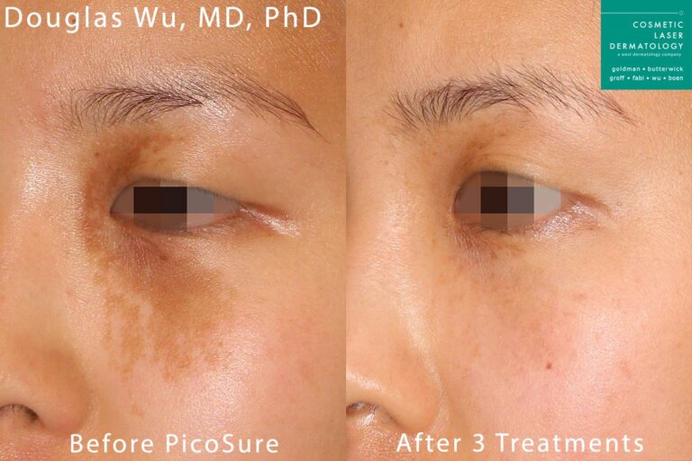 Picosure laser used to remove birthmark from around the eye by Dr. Wu. After 3 treatments, mark is virtually undectable.