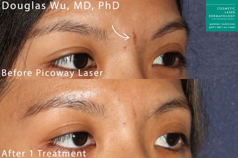Picoway laser to remove cafe au lait macule by Dr. Wu. After one treatment, birthmark is nearly gone.