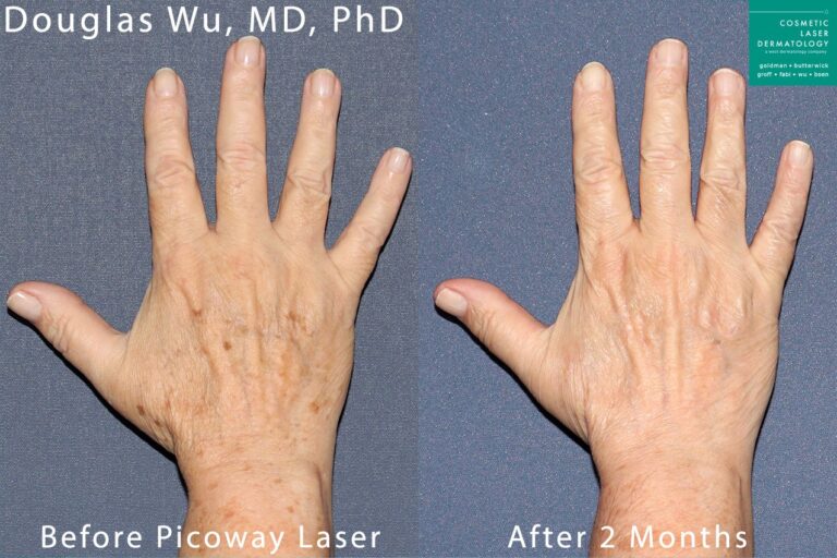 PicoWay laser to remove brown spots from hands by Dr. Wu. Treatment eliminates hyperpigmentation to create smoother, more youthful hands.
