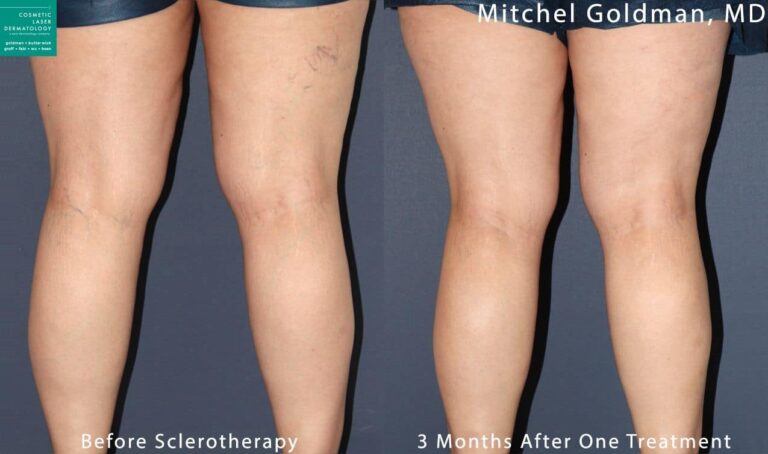 Sclerotherapy to remove visible leg veins by Dr. Goldman. After one treatment, veins are gone.
